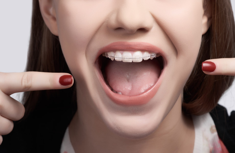 girl pointing at accelerated or traditional braces