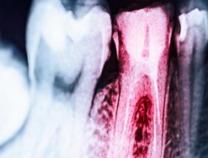 X-ray of teeth and root canals