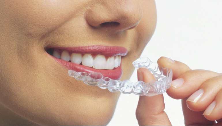 woman inserting clear aligner for teeth straightening