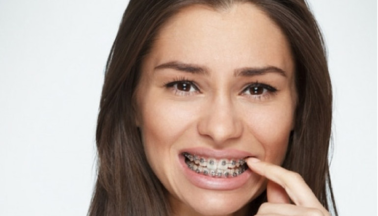 girl grimaces as she picks food out of her metal braces