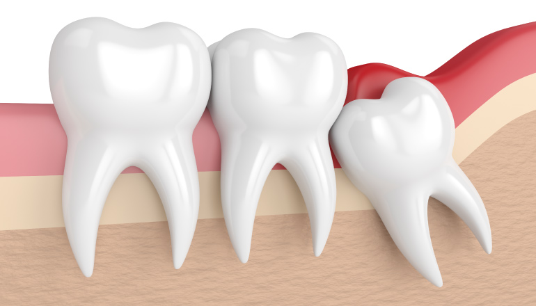 Artistic rendering of a wisdom tooth