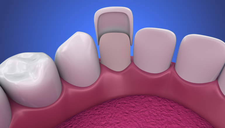 Artistic rendering of porcelain veneers placed over teeth