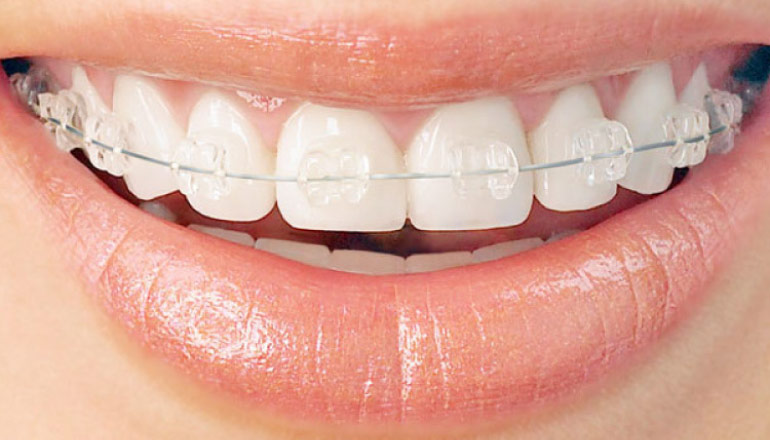 six month smiles clear braces in Baton Rouge