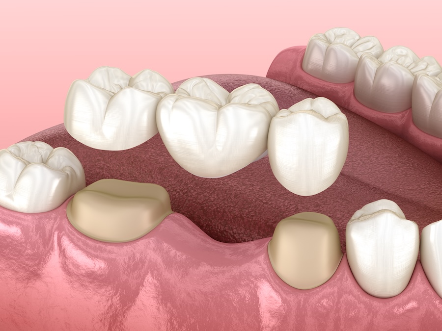 image of traditional dental bridge