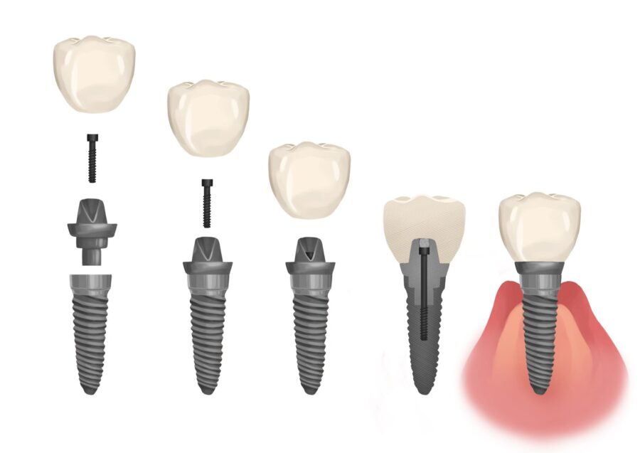 dental implant, dental implants