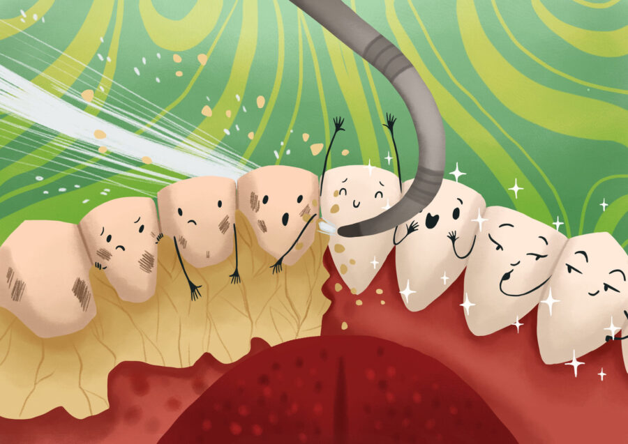 image of a deep cleaning on teeth with removal of plaque and tartar