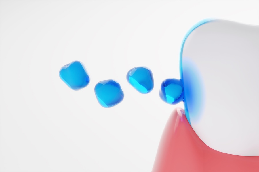 fluoride treatment, fluoride varnish